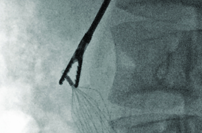 Complex Retrieval Of Embedded Inferior Vena Cava Filters – Penn Medicine